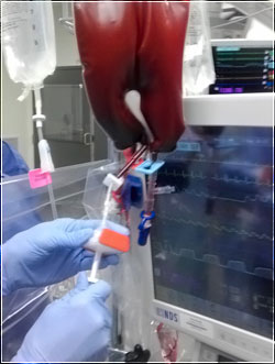 The Hemobag - Patients receive the most complete and comprehensive restoration of their blood components and functionality, resulting in a faster and more complete recovery